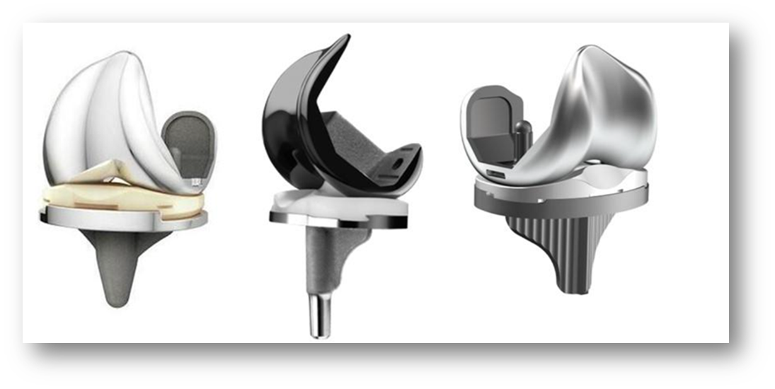 Evolution of Total Knee Replacement Implants from Early Designs to Advanced Technologies